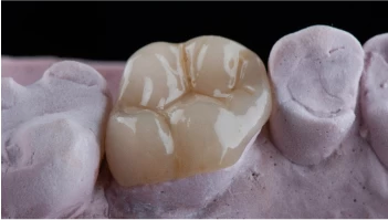 Mặt dán inlay/onlay/veneer ZIRCONIA