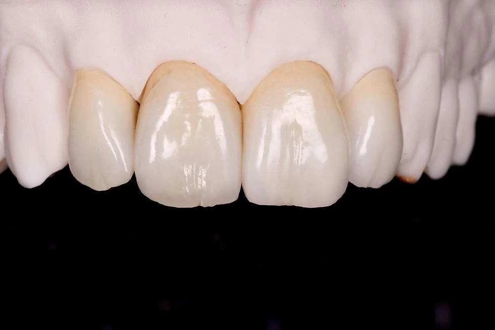 Răng sứ Zirconia AI